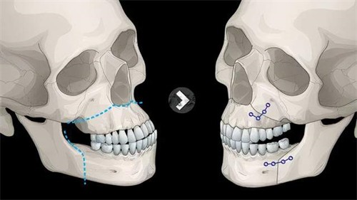 雙鄂手術頭骨動畫示意圖
