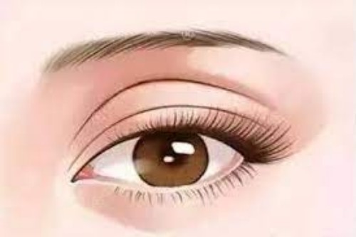 雙眼皮修復手術展示圖