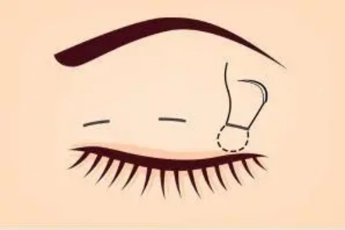 眼修復手術展示圖