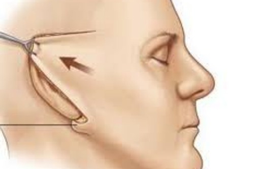 拉皮手術展示圖